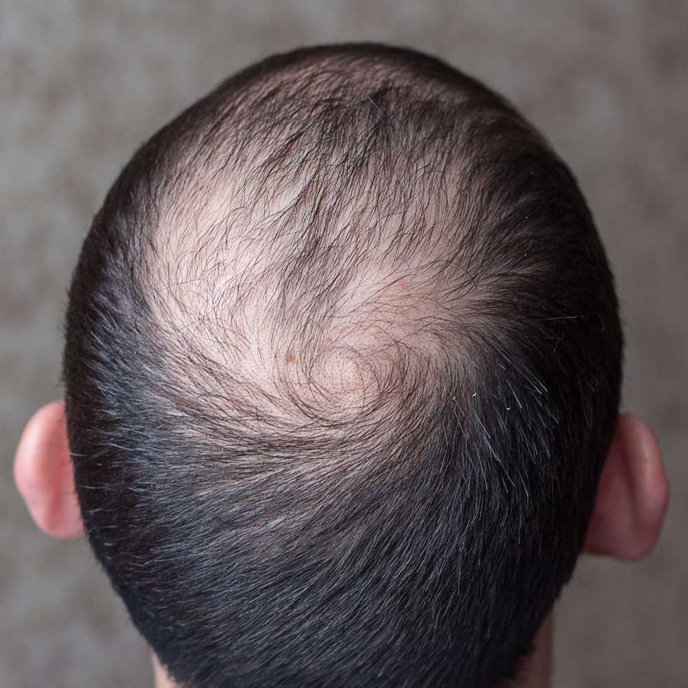 alopecia tratamiento quito