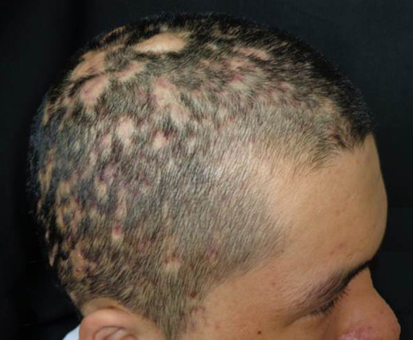 celulitis disecante del cuero cabelludo
