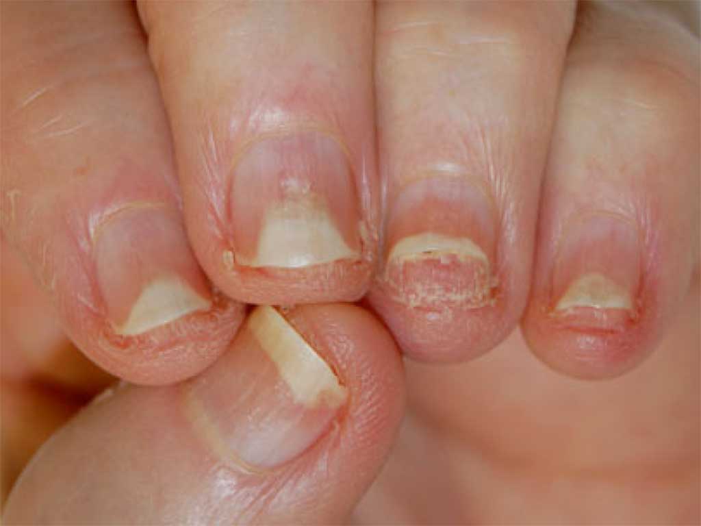 psoriasis uñas