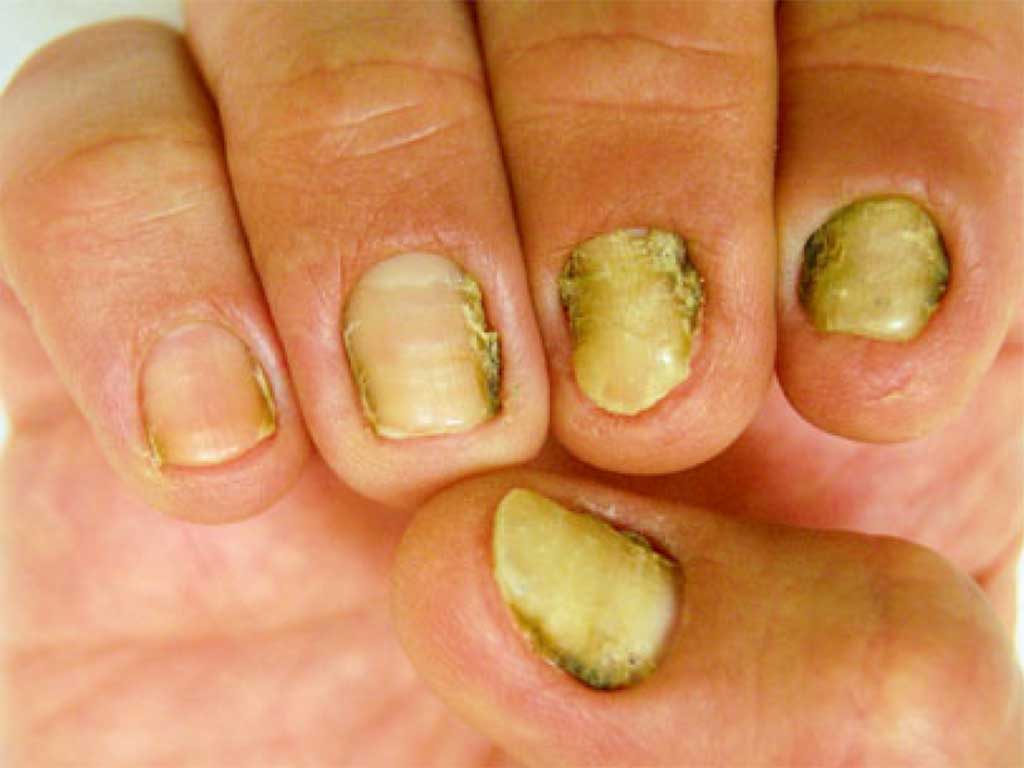 enfermedades de las uñas