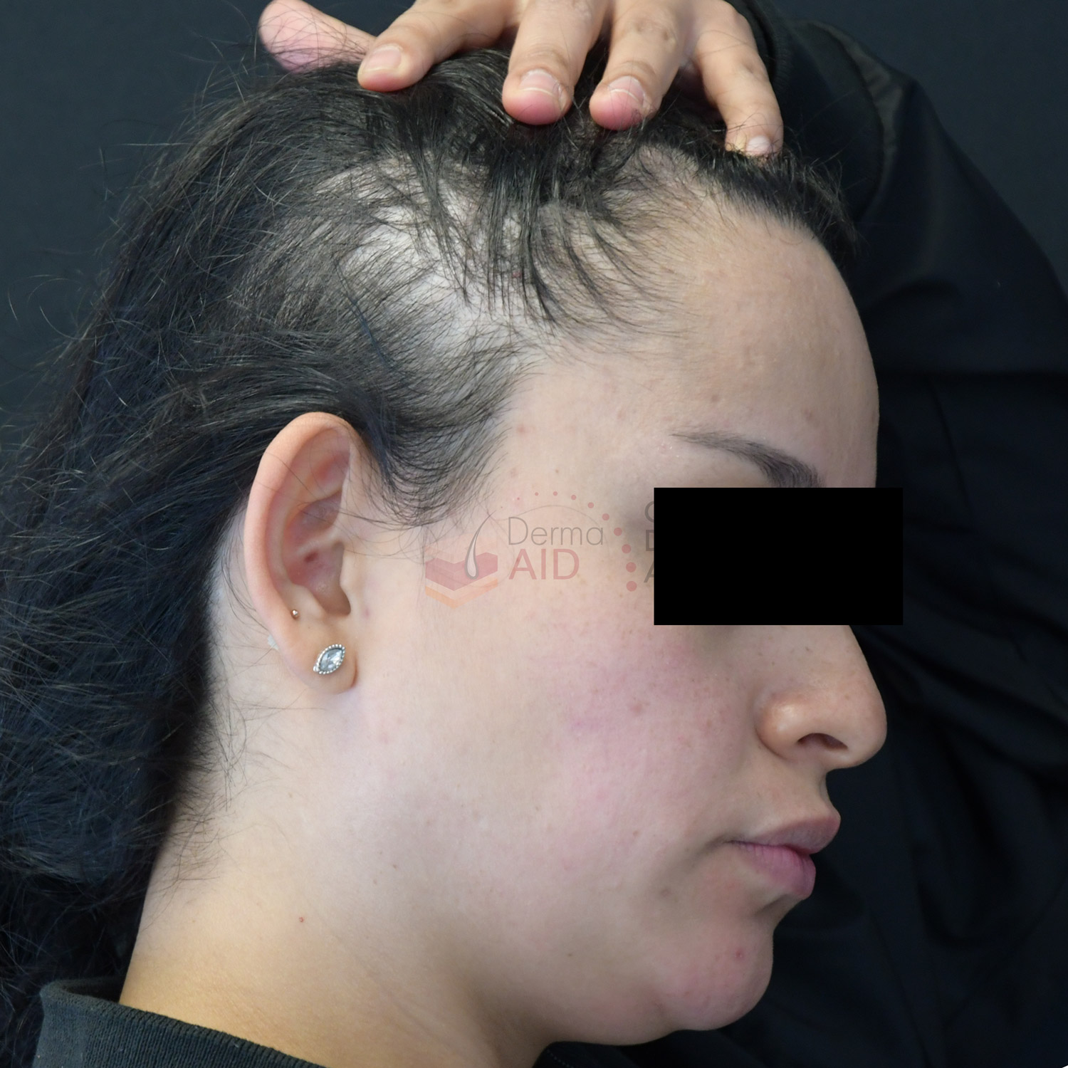 alopecia tratamiento quito